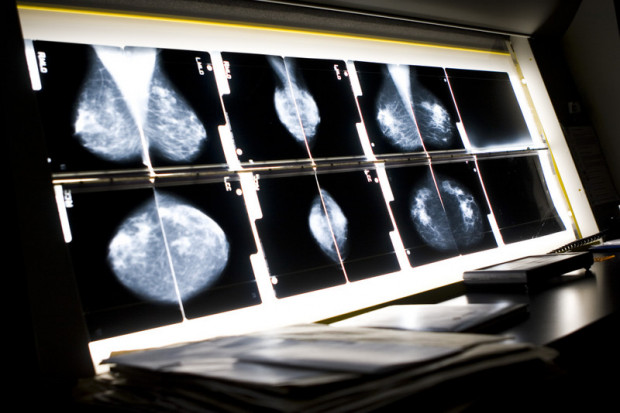 Mammografia: dolegliwości w obrębie piersi nie są już przeszkodą