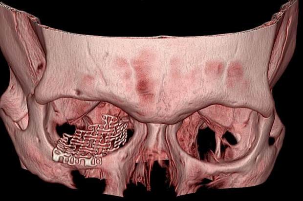 Technologie szybkiego prototypowania przy tworzeniu zindywidualizowanych implantów