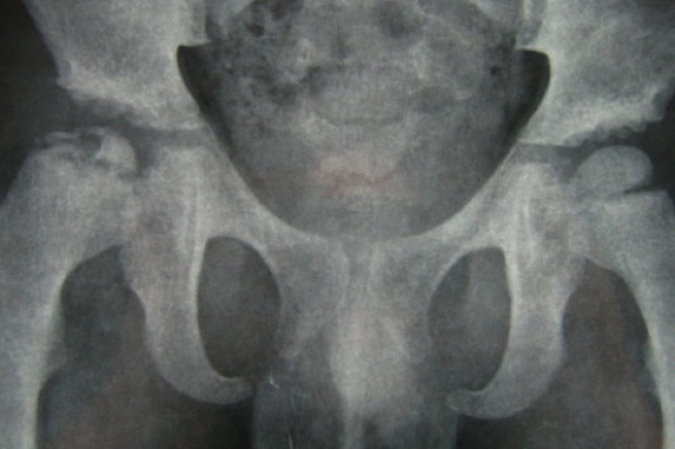 Radiologiczna ocena zborności stawów biodrowych u dzieci z mózgowym porażeniem dziecięcym