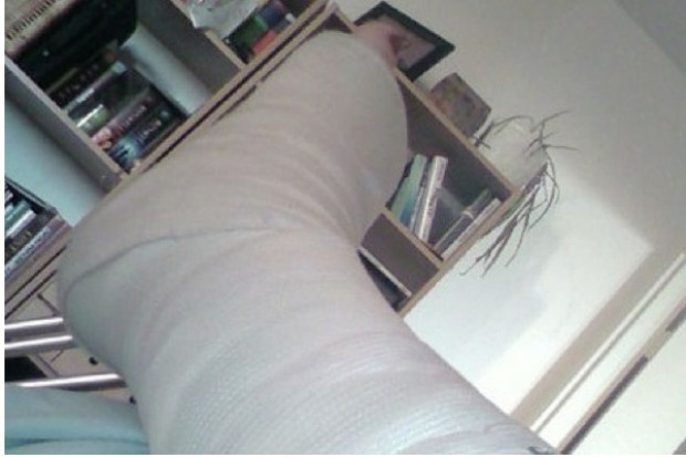 Osteoporoza: zimą wzrasta ryzyko złamań