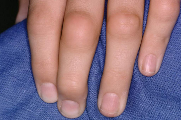 Możliwości diagnostyczne ultrasonografii w RZS - czy doceniane?