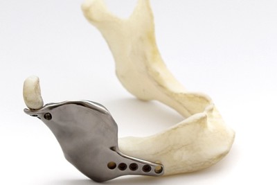 Tak powstawał tytanowy implant z drukarki 3D, wszczepiony pacjentowi