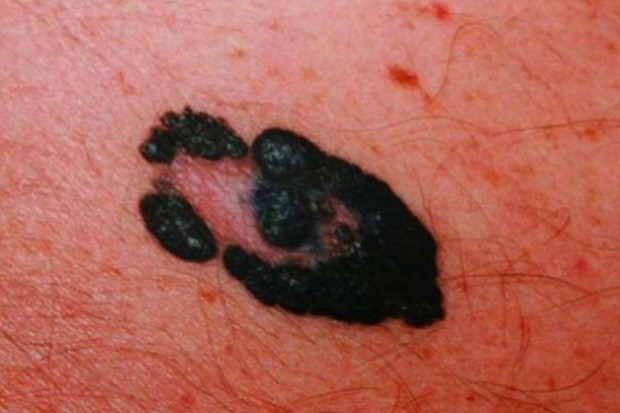 Dermatoskop pozwala na szybkie wykrycie raka skóry