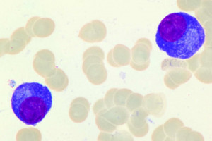Szpiczak plazmocytowy, nowotwór złośliwy układu krwiotwórczego. Fot. Archiwum Rozpoczęła się kampania wczesnej diagnostyki szpiczaka plazmocytowego