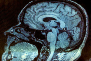 Farmakologiczne wspomaganie możliwości mózgu może być pułapką