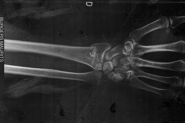 Rzęski komórek kości pomogą pokonać osteoporozę?