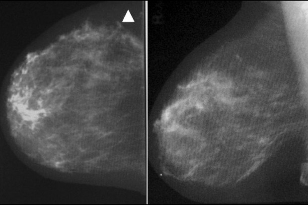 Pomorze: kobiety niechętne mammografii