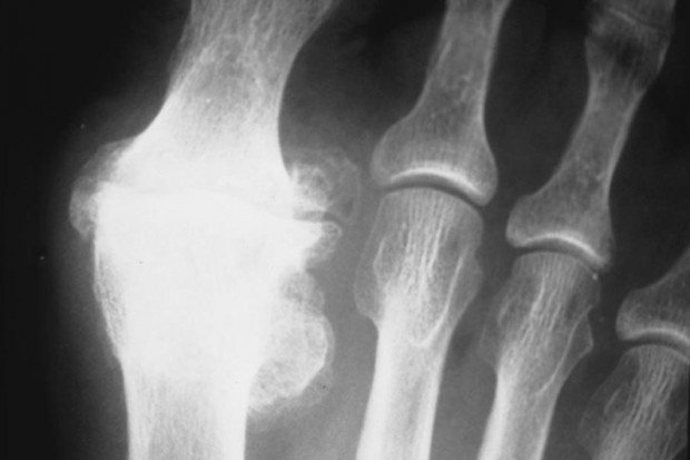 Krakowskie Centrum Rehabilitacji: endoprotezy dla hemofilików