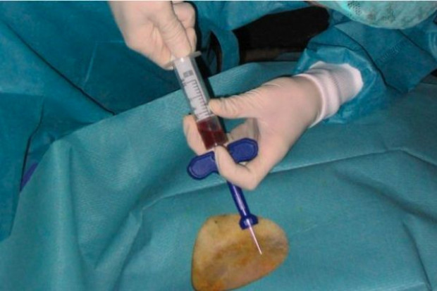 Hematolodzy: Polacy zaniedbują badanie krwi