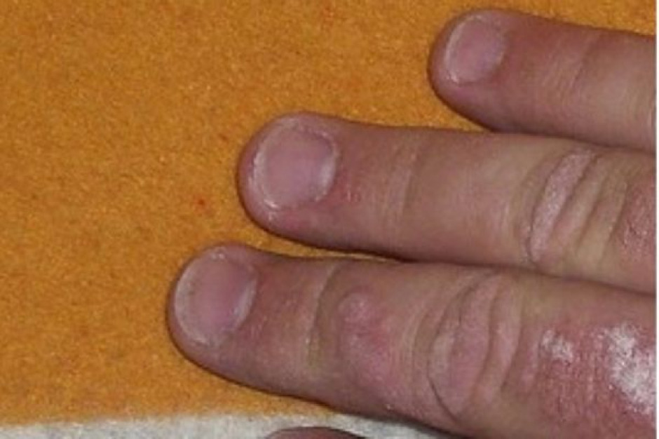 Dermatolodzy: wprowadźmy wreszcie leczenie biologiczne w łuszczycy