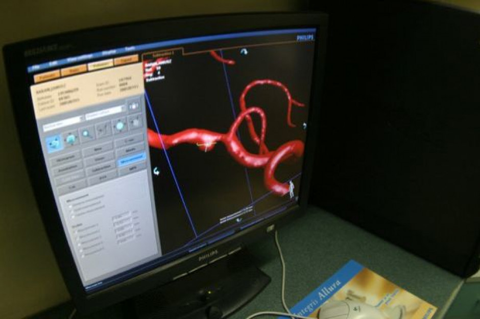 Leczenie mechaniczną trombektomią daje spektakularne efekty. Fot. PTWP Opole: pacjent po ostrym udarze dzięki trombektomii odzyskał pełną sprawność
