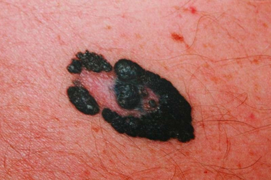 Poznań: czy znajdą się pieniądze na szczepionkę przeciwko czerniakowi?
