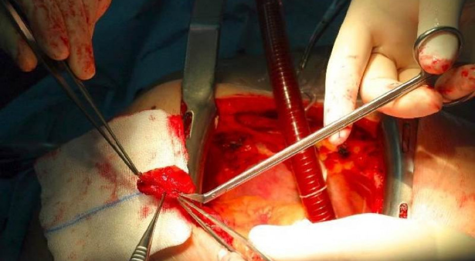 Poznań: kardiochirurdzy gotowi przeszczepiać serca dzieciom