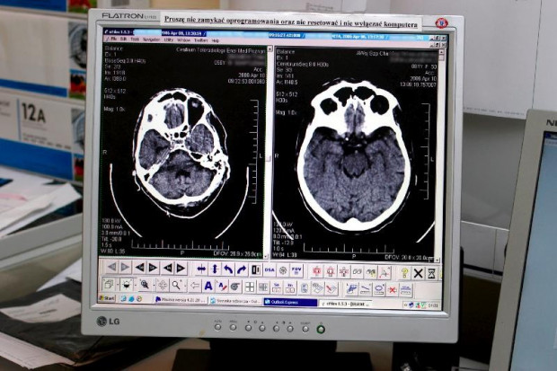 Powstawanie nowych neuronów w mózgu kluczowe w leczeniu depresji