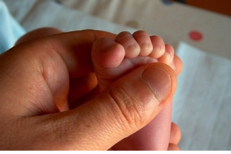 Infantile hemangioma - naczyniak o typie truskawki
