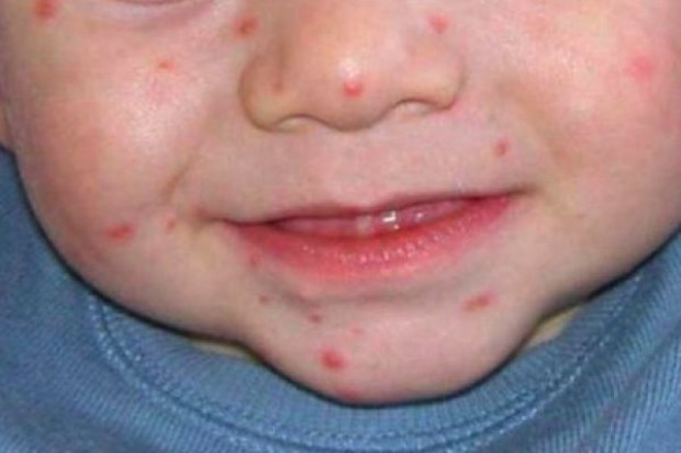 Świadomie zarażają dzieci chorobami zakaźnymi. Czy wywołają epidemię?