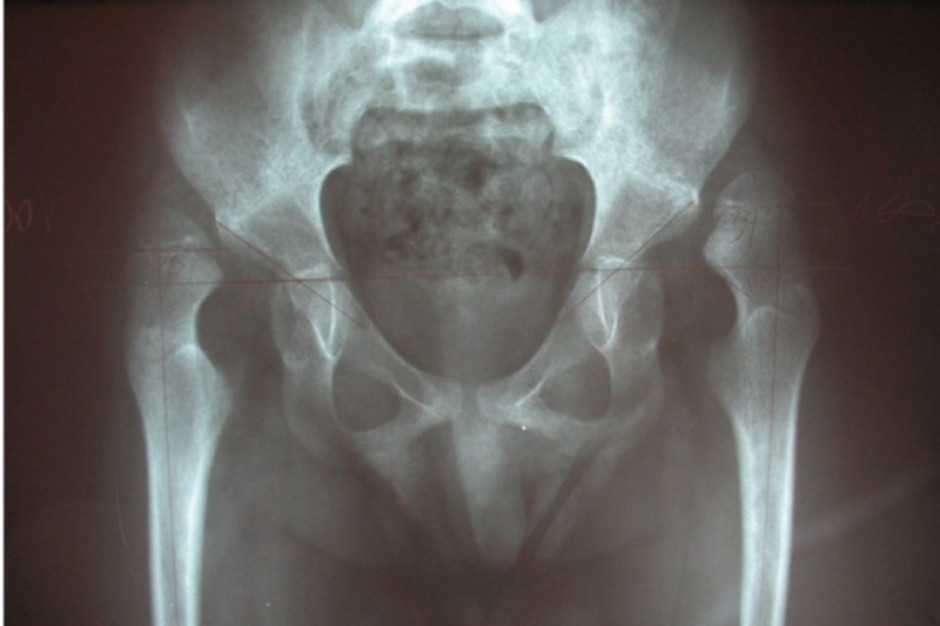 Nowa powłoka dla implantów sprzyja wzrostowi kości