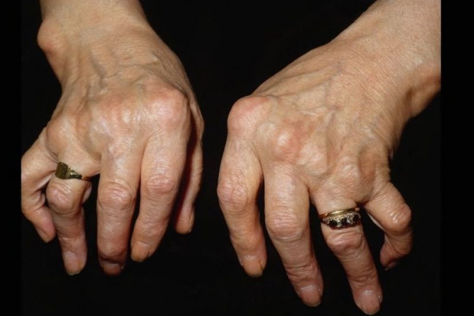 W reumatologii znika terapia inicjująca - ważna zmiana w leczeniu biologicznym