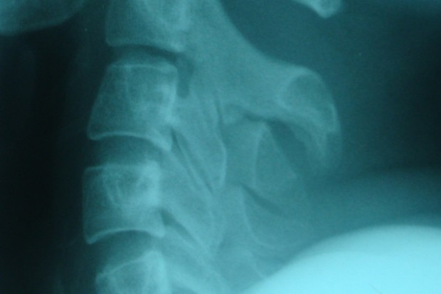 Osteosarcoma problemem również dorosłych