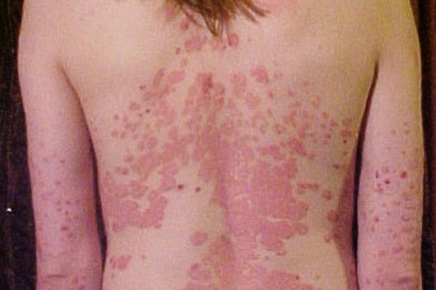 Dermatolodzy: łuszczycy nie da się wyleczyć kolejnymi obietnicami