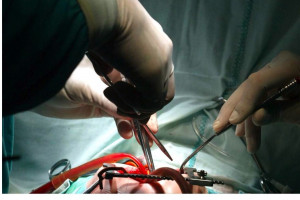 Operacja kardiochirurgiczna zamiast przeszczepu płuc 