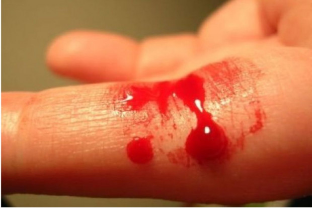 Eksperci: z leczeniem hemofilii w Polsce ciągle wiele problemów