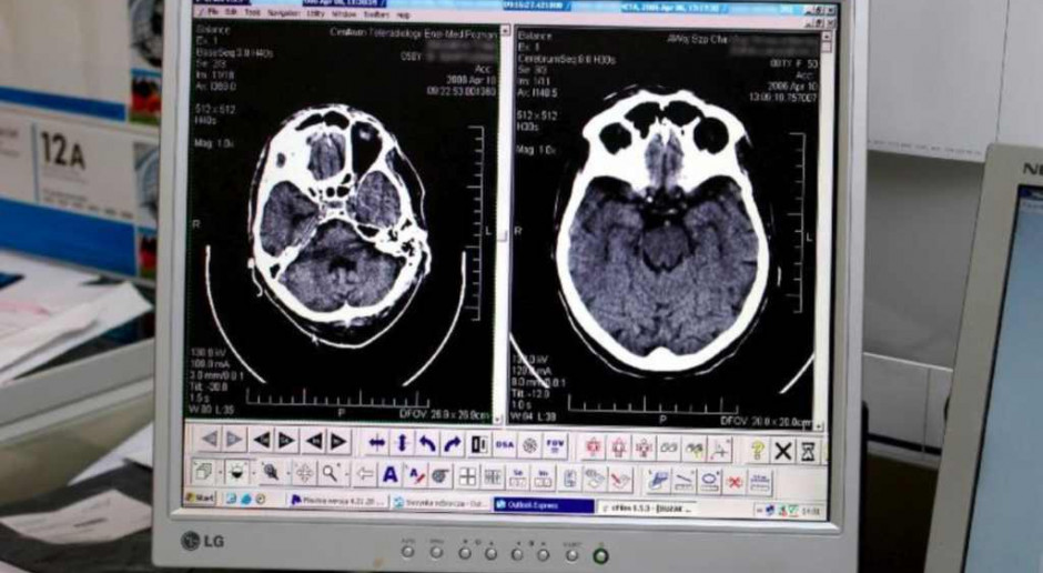 Udar mózgu: chorzy potrzebują szybkiej interwencji medycznej
