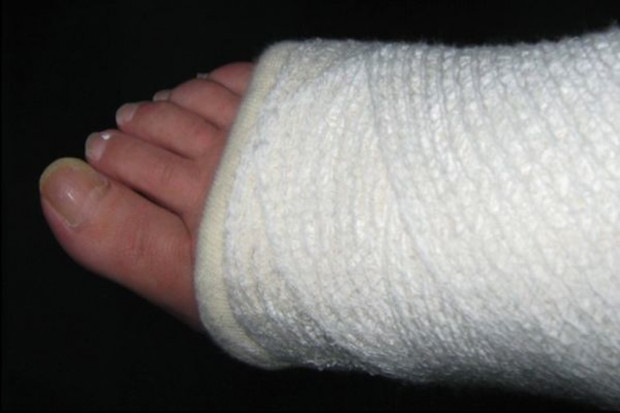 Kto ma zdjąć gips z nogi, czyli nic śmiesznego
