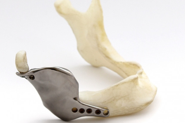 Tak powstawał tytanowy implant z drukarki 3D, wszczepiony pacjentowi