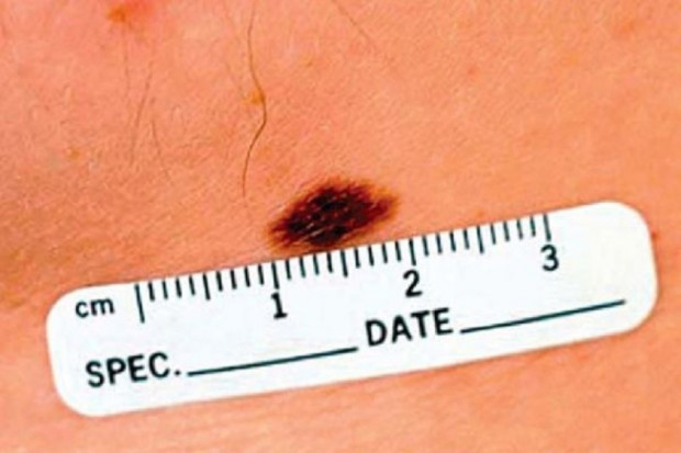 Wrocław: szpital zaprasza na bezpłatne badania dermatologiczne