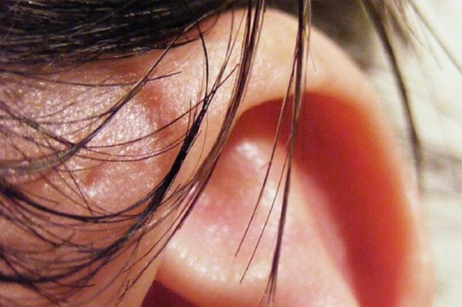 Kajetany: pierwszy w Polsce zabieg wszczepienia nowego implantu ucha środkowego typu MET