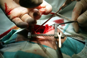 Wyjątkowa operacja z celowym zatrzymaniem serca w Bytomiu