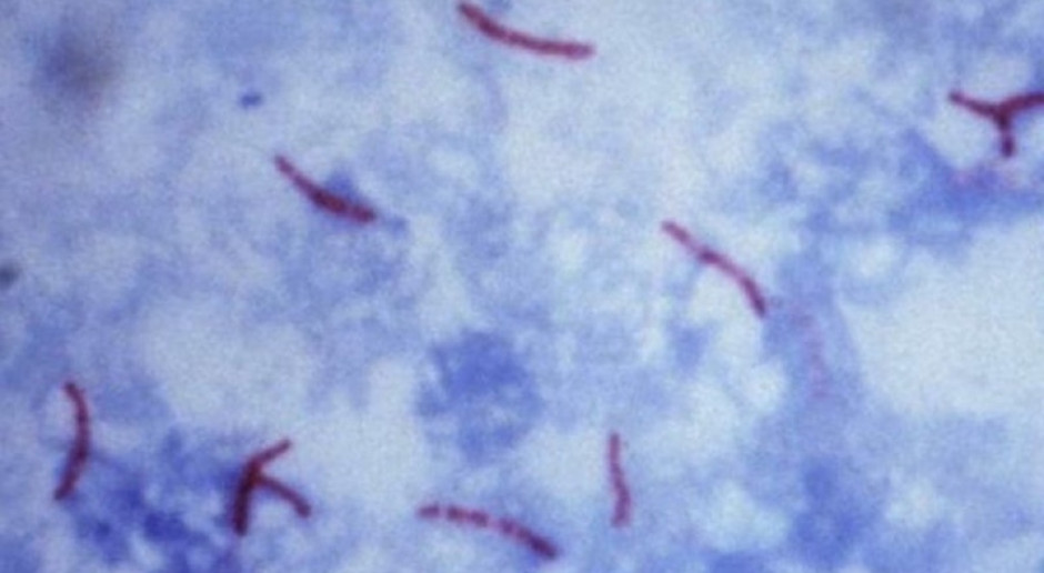 Raport: co godzinę 30 przypadków gruźlicy w Regionie Europejskim WHO
