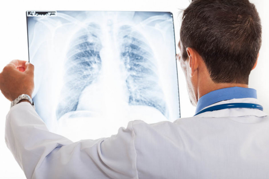 Fot. Shutterstock (zdjęcie ilustracyjne) Badania: rak płuc wśród niepalących jest częstszy niż się wydaje