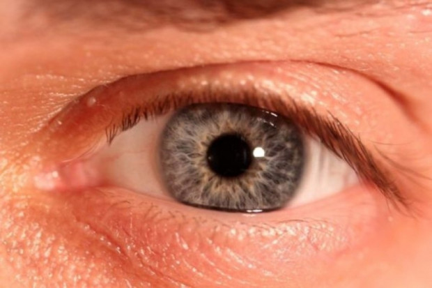 W cięższej postaci retinopatia cukrzycowa może prowadzić do ślepoty Fot. Archiwum Coraz więcej osób traci wzrok z powodu retinopatii cukrzycowej