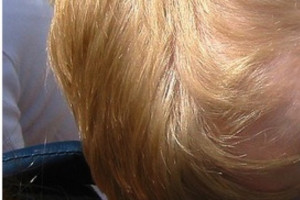 Naukowcy: enzym we włosach może być wczesnym biomarkerem schizofrenii