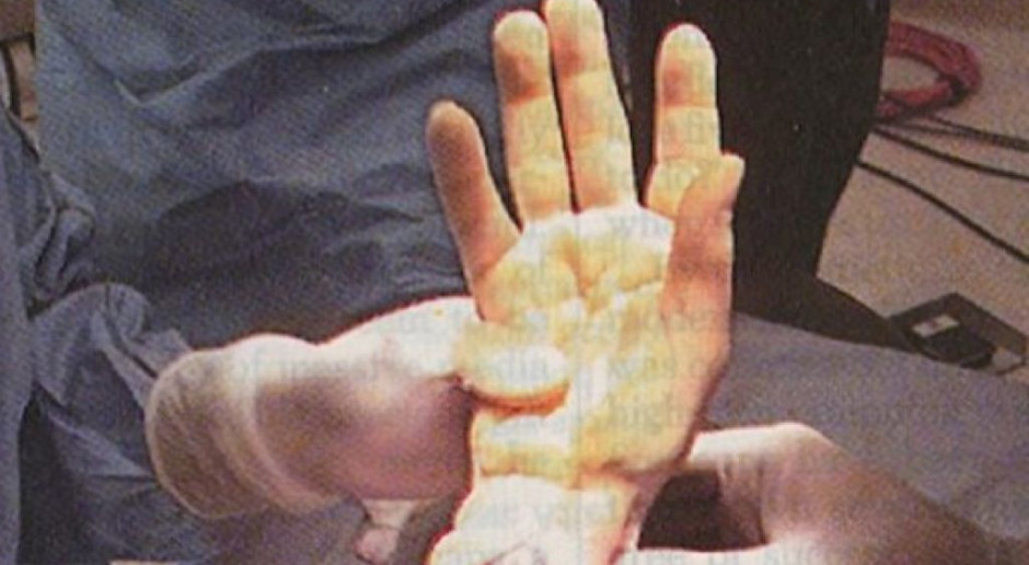 Wrocław: przeszczepiono dłoń dorosłemu pacjentowi, który urodził się bez tej części ciała