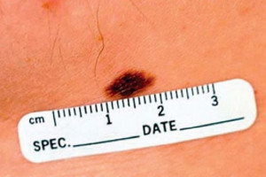 Pierwszy na świecie test krwi na czerniaka umożliwi jego wczesne wykrycie?