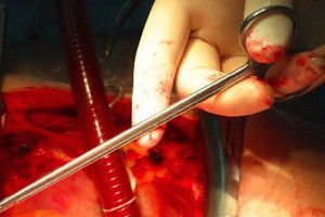 Transplantacje nerek w Szczecinie wznowione. Transplantologia też się powoli "odmraża"