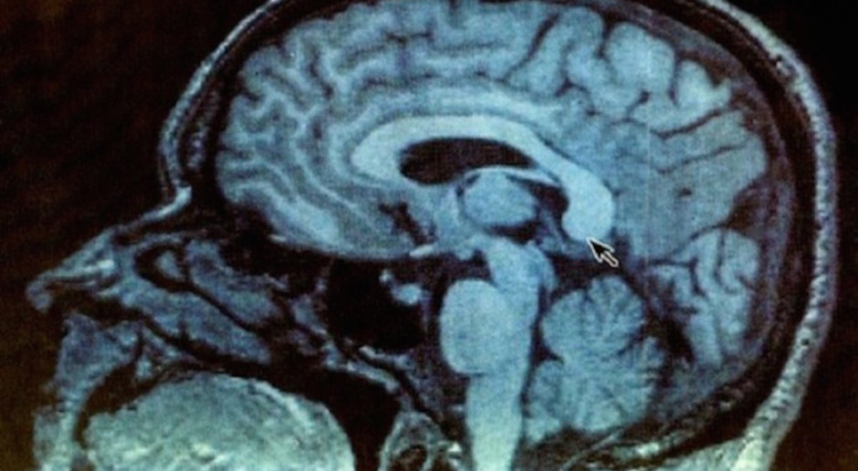 Odkryli połączenie mózgu z układem odpornościowym poprzez naczynia limfatyczne