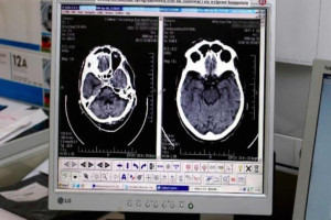 Badania: rezonans wykazał zmiany w mózgach pacjentów z ciężkim przebiegiem COVID-19