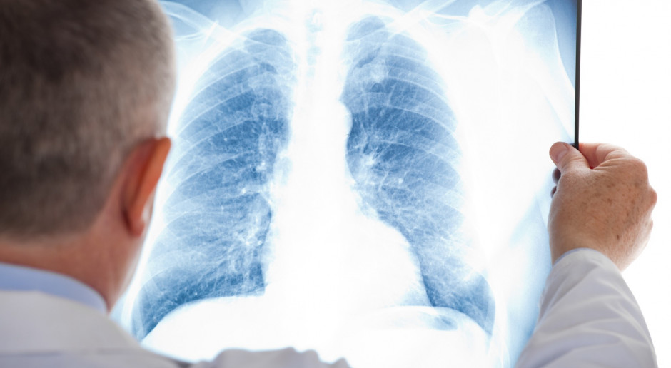 Specjaliści: zaawansowany rak płuca staje się chorobą przewlekłą