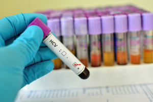 Badanie anty-HCV pozwoli wykryć zakażenie wirusem HCV. Można go zrobić bezpłatnie