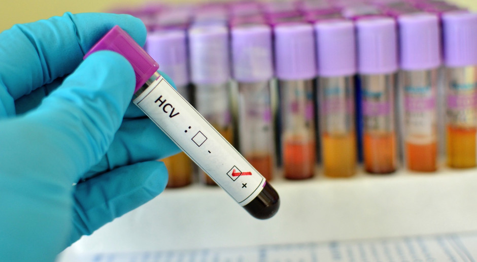 NFZ ma pomysł na tańsze leczenie HCV, lekarze i pacjenci są sceptyczni. Fot. materiały prasowe NFZ ma pomysł na tańsze leczenie HCV, lekarze i pacjenci są sceptyczni