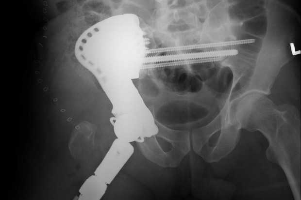 Implant dedykowany pacjentowi został stworzony we współpracy z amerykańskimi specjalistami Fot. Szpital im. W. Degi Poznań: wszczepili pacjentowi największy w Europie implant ortopedyczny