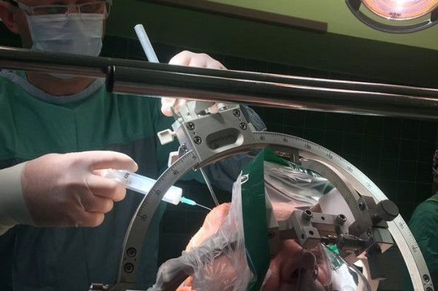Operacja trwała sześć godzin i zakończyła się pełnym sukcesem. Już w trakcie zabiegu obserwowano ustępowanie objawów choroby - mówi neurochirurg dr Dariusz Łątka. Fot. Materiały prasowe Opole: neurochirurdzy z WCM wszczepili stymulator DBS