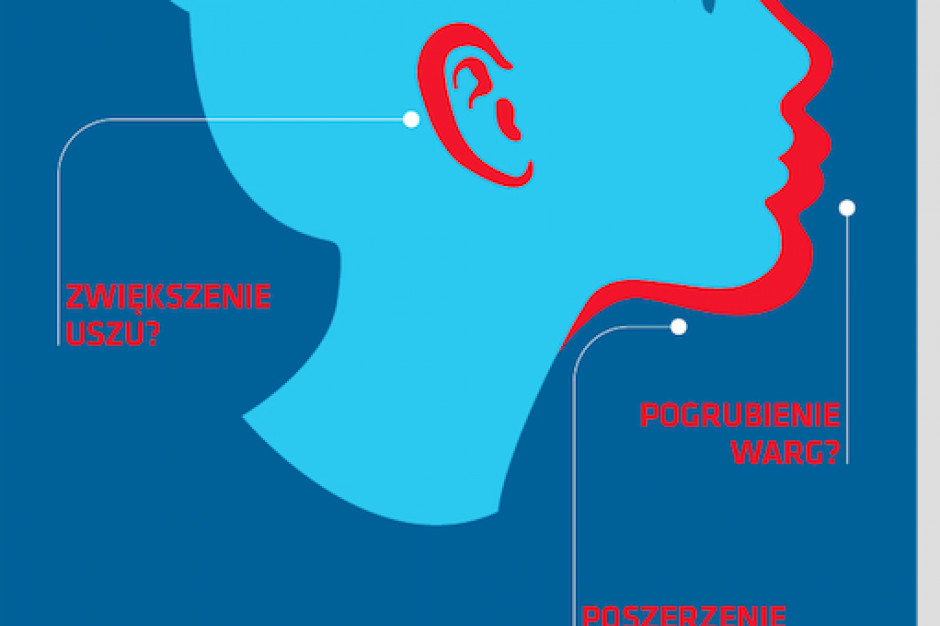 Akromegalia to choroba o podłożu hormonalnym, która powoduje nieprawidłowy wzrost kości i tkanek miękkich. Fot. Archiwum Kilkuset chorych na akromegalię może być w Polsce niezdiagnozowanych - wskazują eksperci