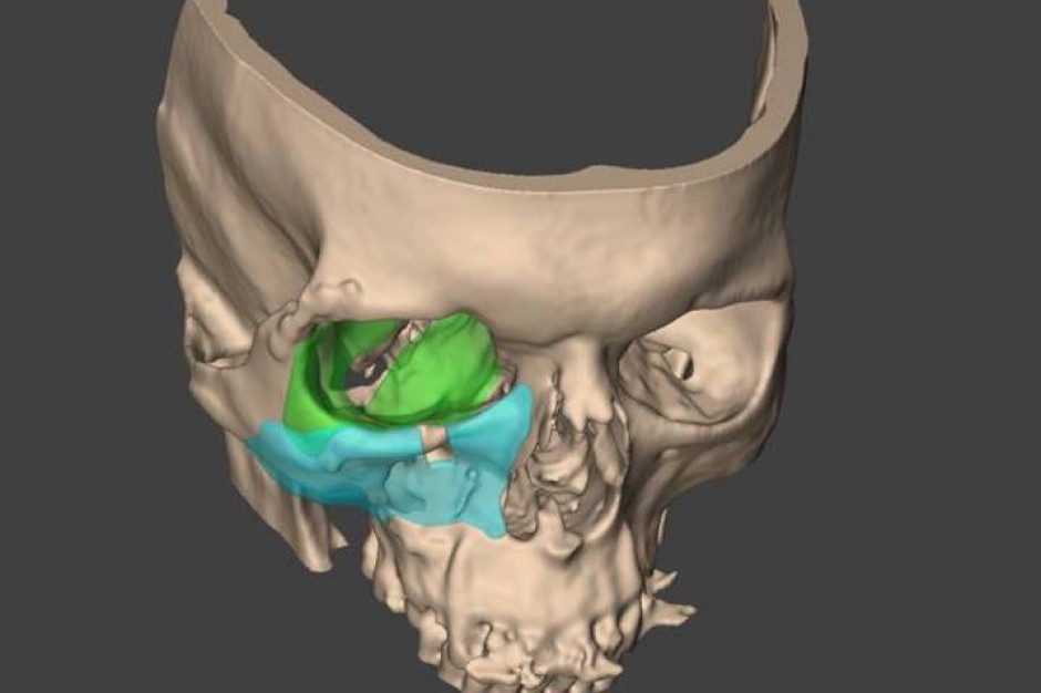 Wizualizacja implantu wszczepionego pacjentowi. Fot. mat. prasowe szpitala Katowice: wszczepili unikalny implant 3D kości twarzoczaszki