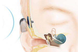 Olsztyn: szpital dziecięcy będzie wszczepiał implanty słuchowe zakotwiczone w kości