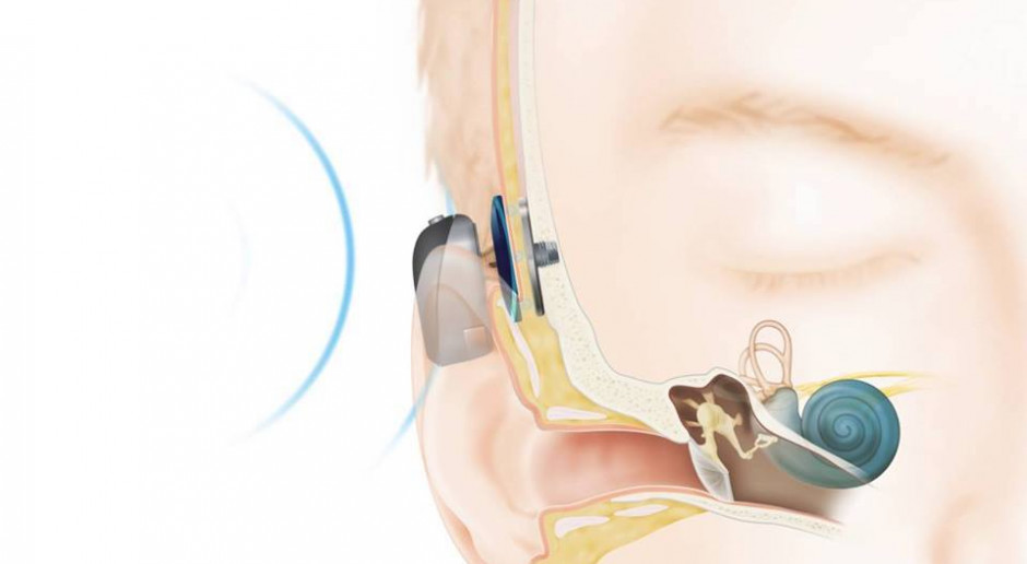 Olsztyn: w szpitalu dziecięcym będą wszczepiać implanty słuchowe